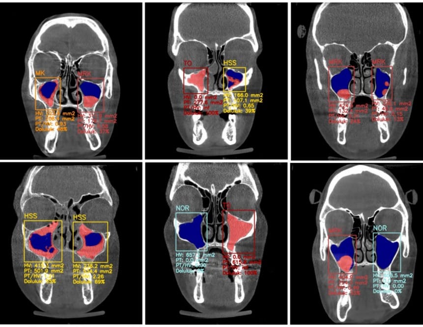 Diş Hekimliğinde Yapay Zekâ Dönemi: Teşhiste %99 Doğrulukla "Sıfır Hata" Hedefi
